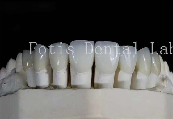 Polsterte Zahnlaminaten Veneers hohe Durchsichtigkeit für natürlich aussehende Lächeln