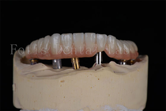 Erschwinglich Natürlich aussehen 4 oder 6 Implantate Vollbogen Erfolgsrate Minimalinvasive Lösung