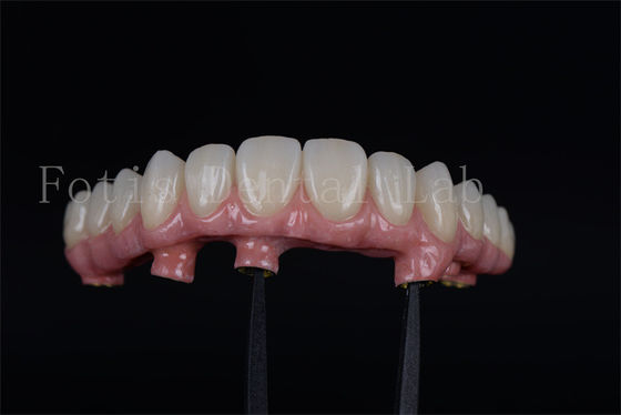 Natürliche Wiederherstellung der Kaugfähigkeit mit 4 oder 6 Implantaten