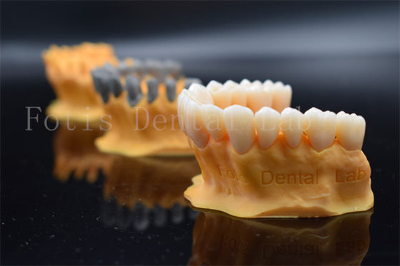Schnelle Full Ziconia Design Digital Kronen 3 Form / Exo Design Am selben Tag Herstellung