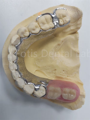 Ersetzen fehlender Zähne Entfernbarer Teilprothese Zahnprothese Flexibles Design