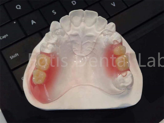 Flexible TCS Valplast Zahnmedizin Komfortable langlebige Gestaltung
