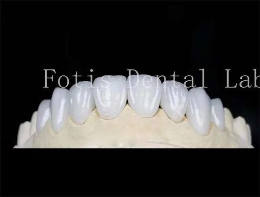 Natürliche Farbe Zahnlaminat Veneers Falsche Zähne Veneers mit Bindungszement