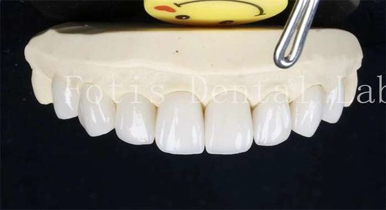 0.3-0.5mm Keramik-Laminat-Zähne Falschzähne Furniere mit Klebstoff-Bindungs-Zement