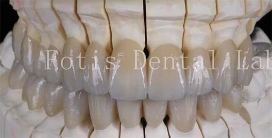 Natürlich aussehendes Lächeln Prothese Porzellan Laminat Veneers Glatte Oberfläche