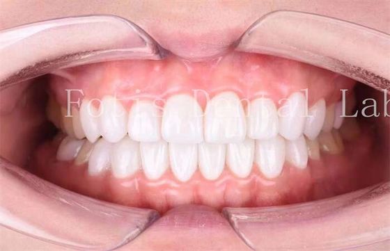 Hochdurchlässige Zahnlaminaten Veneers Langlebigkeit Polierveredelung