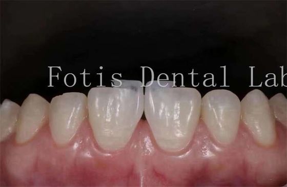 Polstern synthetische Zahnlaminaten Veneers hohe Fleckenbeständigkeit