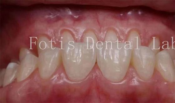 0.3-0.5mm Dicke Kosmetische Zähne Decken Veneers für kosmetische Zahnmedizin