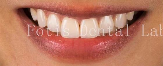 High-End Kosmetik-Zahnfurniere für perfekte Lächeln Fleckenwiderstand