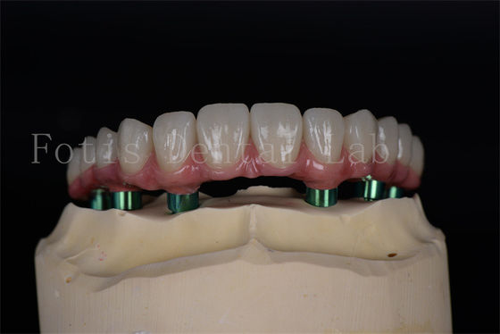 Langlebiges Titan/Zirkonium All on 4/6 Implantate Leichte Wartung Hohe Erfolgsrate