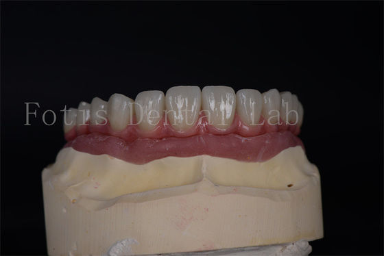 Natürliche Ästhetik mit erschwinglichen All-on-4-All-on-6-Implantaten