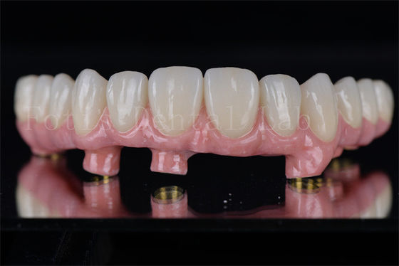 Alle auf 4 alle auf 6 Implantate wiederherstellen die vollständige Kaugfähigkeit