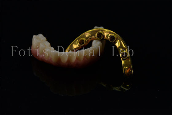 Titanium Zirkonia All On 4 All On 6 Implantate Volllächeln Implantate lebenslange Garantie