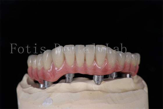 Minimal invasiv am selben Tag alle auf 4 alle auf 6 Implantate natürlich aussehen leicht zu reinigen