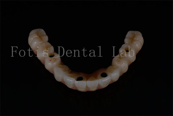 Ersatz von All-on-4 All-on-6-Implantaten für eine optimale Funktionsfähigkeit