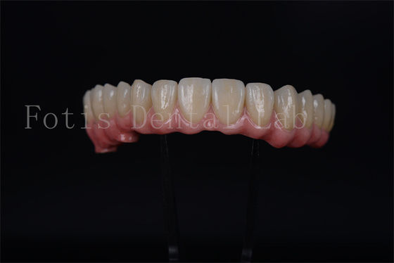 Vollbogen-Implantatbrücke Alle auf 4 Alle auf 6 Für die vollständige Zahnrestaurierung