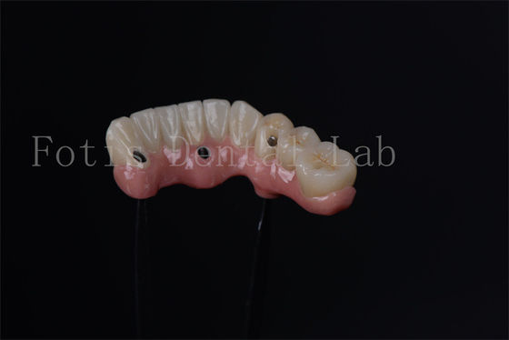 Alle auf 4 alle auf 6 Endostealimplantate für den sofortigen Zahnersatz