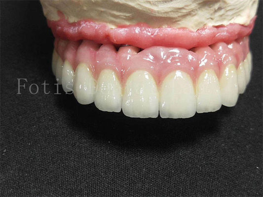 Titanium / Zirkonia Implantatkrone polierte Veredelung künstliche Zahnkrone