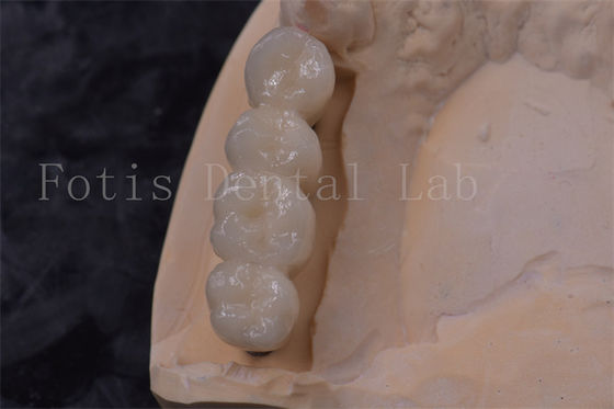 Präzisionsfit Zirkonia Zahnkrone Implantat PFM Krone leicht zu reinigen