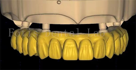 OEM-Dentalkronen-Design verwendet fortschrittliche Scanning- und 3D-Drucktechnologie