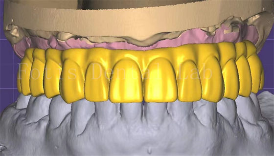 Professionelles 3Shape-Kronendesign hervorragende Leistung und Langlebigkeit