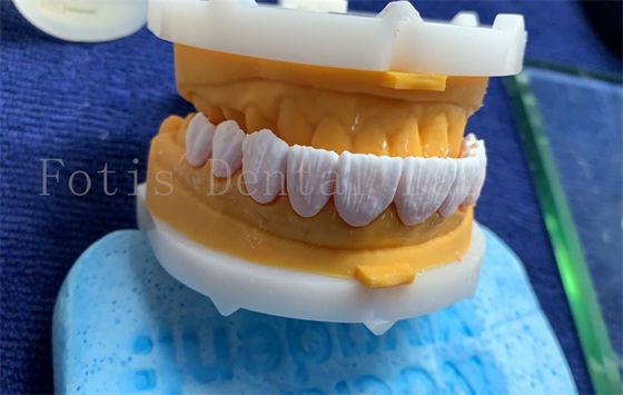 Erweiterte digitale Zahnkronen Implantat Dentrue Krone FDA/ISO/CE zertifiziert