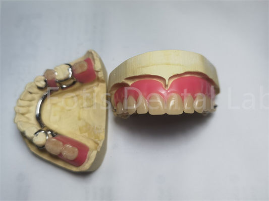 Bequeme Teilprothese / abnehmbare Zahnprothese individuell