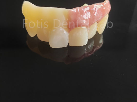 Monolithisches Zirkonia mit Porzellanschicht