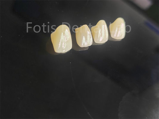 Professionelle Porzellan-Zirkonium-Fusion für perfekt passende Zahnrestaurationen