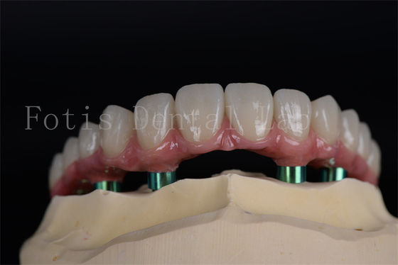 Langlebig All On 4 All On 6 Implantate Natürliche Erscheinung Ästhetik Keine Altersgrenze Wiederherstellung