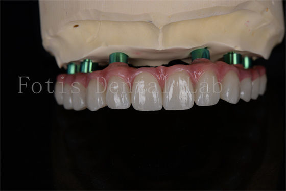 Zirkonia All-on-4 Implantat Verfahren am selben Tag Erholung Mindestnachsorge erforderlich