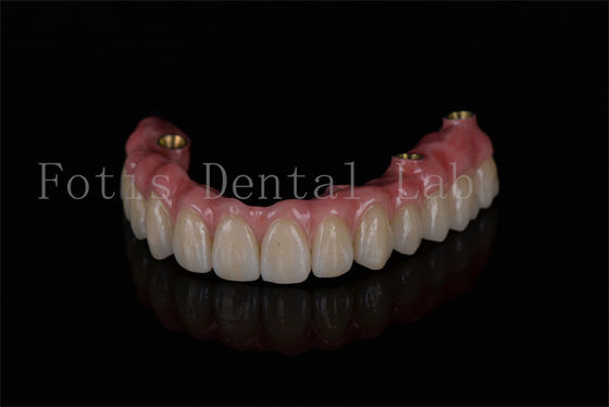 Ein guter Preis. Voll-Bogen-Restaurierung mit vier Implantaten für optimale Zahnimplantate Online