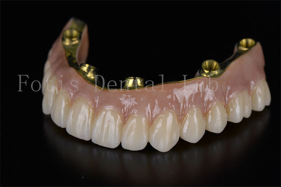 Ein guter Preis. Voll-Bogen-Restaurierung mit sechs Implantaten Online